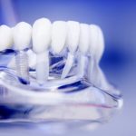 Co to są implanty zębów?