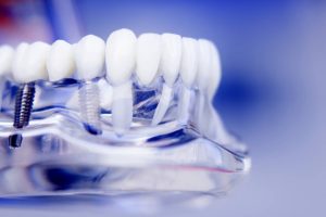 Co to są implanty zębów?